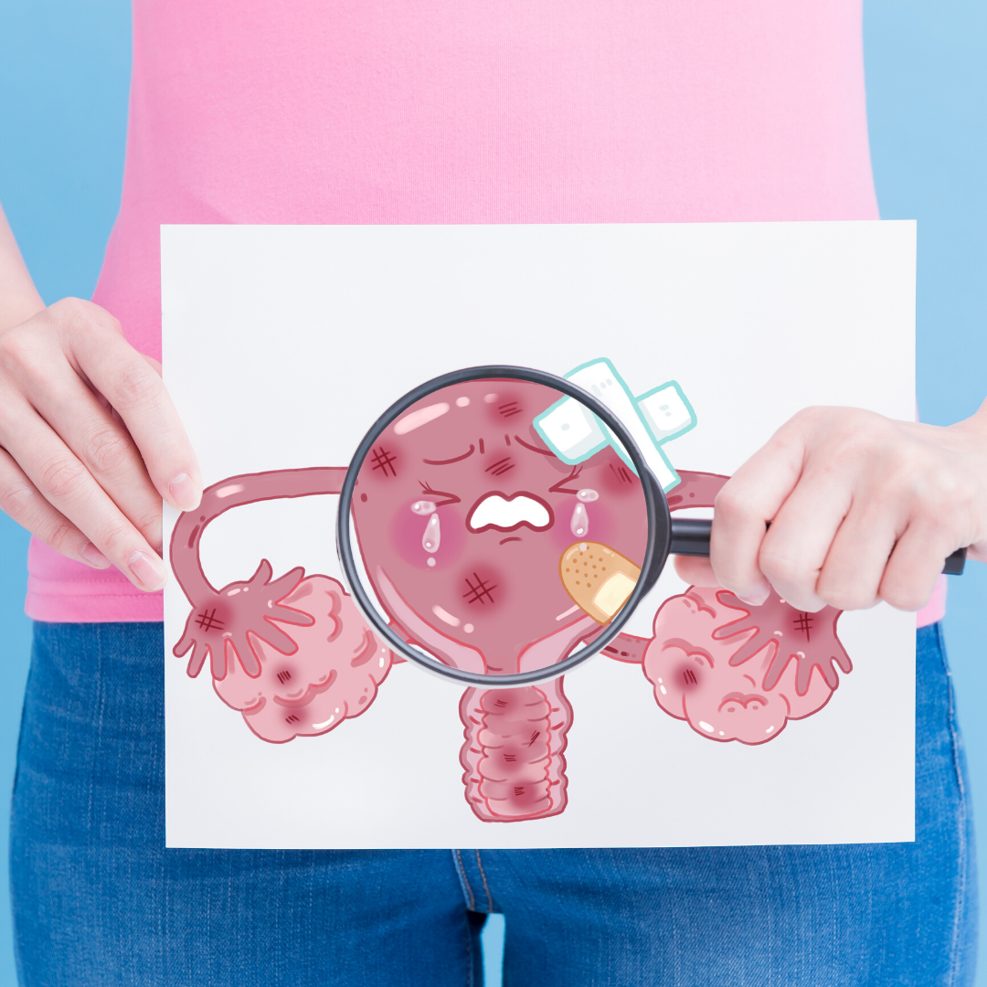 How To Tell If You Have PCOS – Ask Dr. Dee